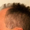 thinning hair reduce with kaf Before and after black styling cream